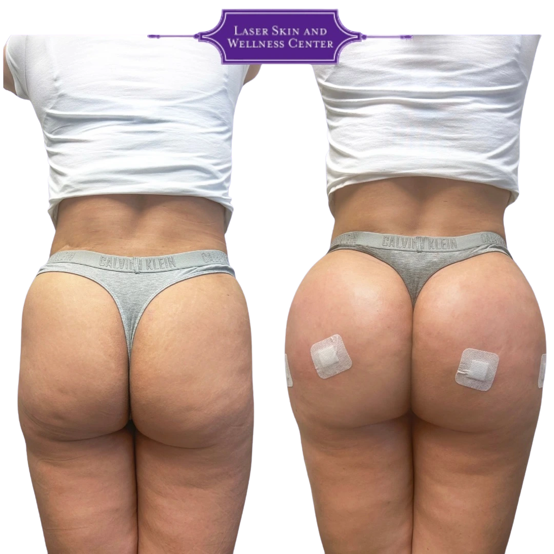Before and after buttock augmentation, rear view showing enhanced volume and lifted contour