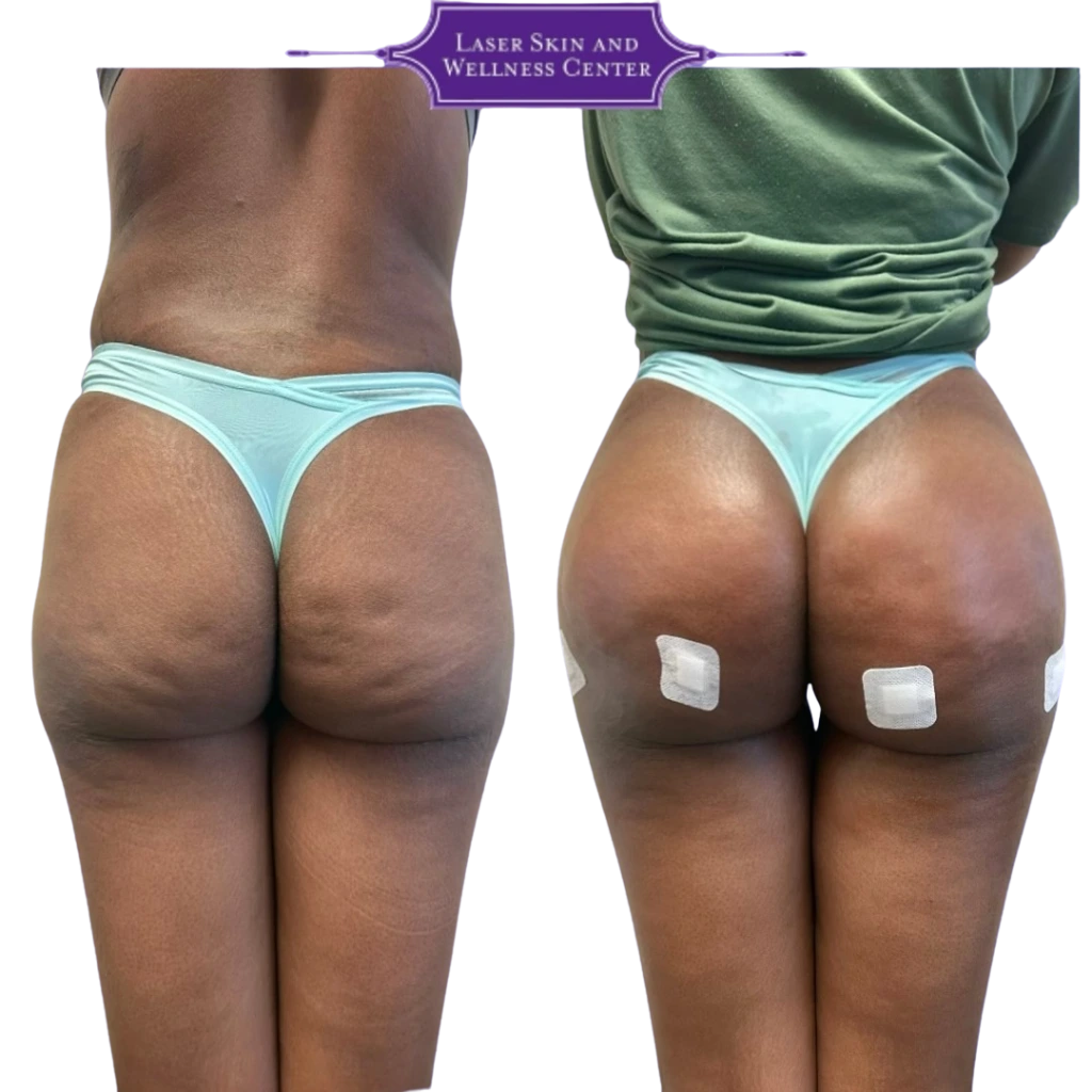 Before and after rear view showing buttocks augmentation with enhanced curves