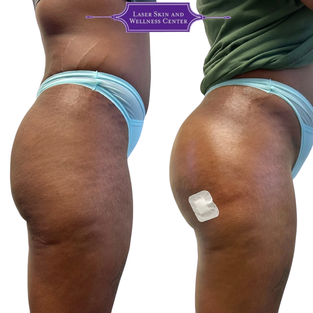 Side-by-side buttocks comparison demonstrating improved contour and fullness
