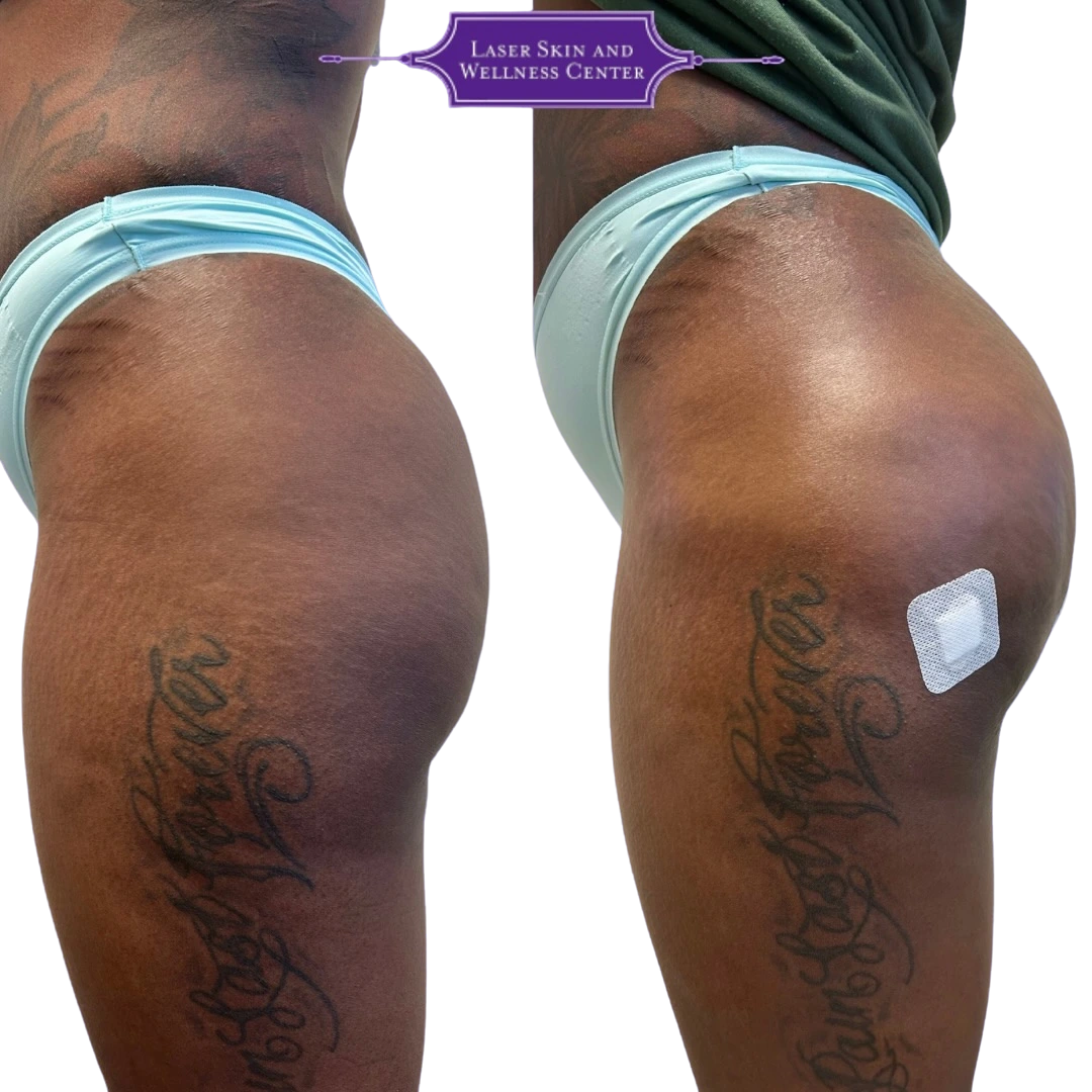 Before and after buttocks with tattoos showing enhanced shape and projection