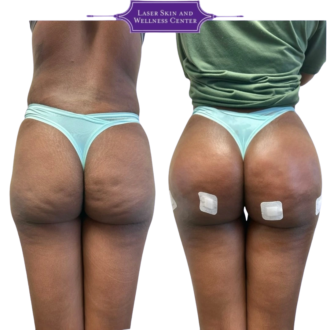Before and after rear view showing buttocks augmentation with enhanced curves