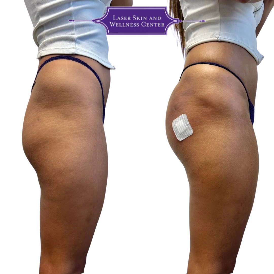 Before and after buttock and thigh contouring with measurement marker, Laser Skin and Wellness Center logo displayed