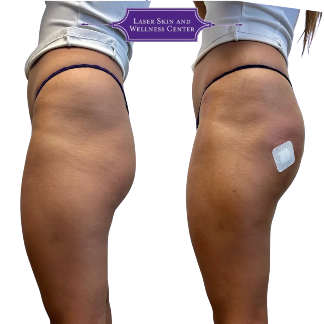 Before and after buttock and thigh enhancement with measurement marker, Laser Skin and Wellness Center logo displayed