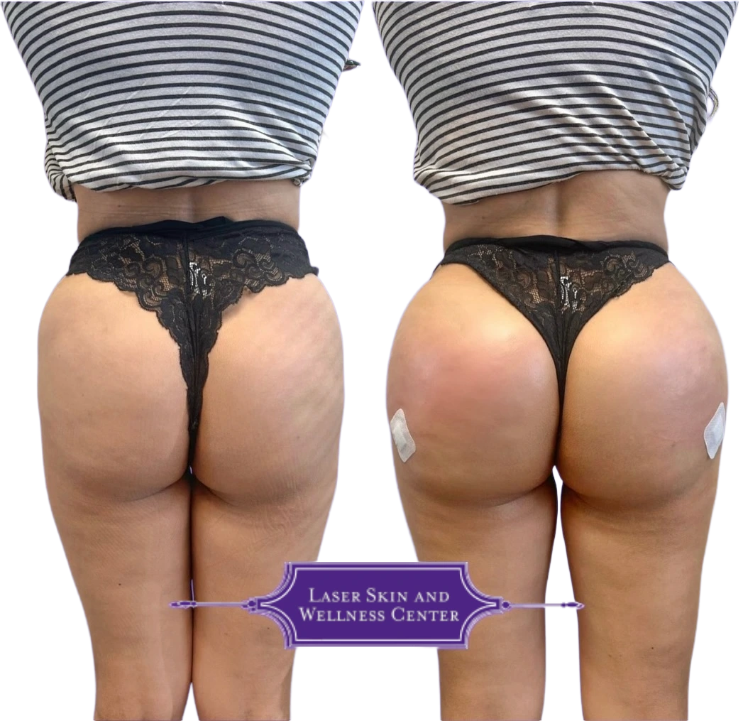 Rear view before and after non-surgical buttock enhancement showing improved volume and definition
