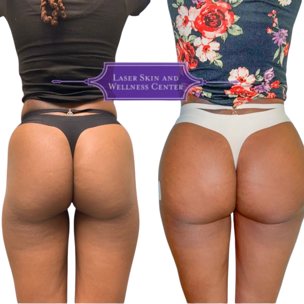 Before and after comparison of non-surgical BBL treatment showing gluteal enhancement from back view with Laser Skin and Wellness Center logo