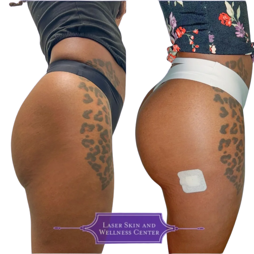 Before and after comparison of non-surgical BBL treatment on tattooed gluteal area from side angle with Laser Skin and Wellness Center logo