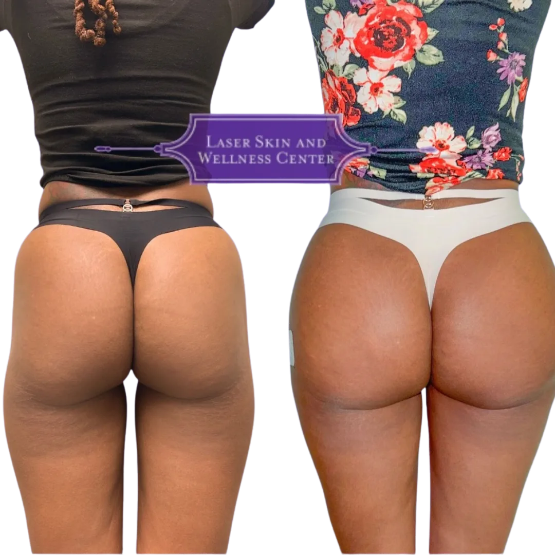 Before and after comparison of non-surgical BBL treatment showing gluteal enhancement from back view with Laser Skin and Wellness Center logo