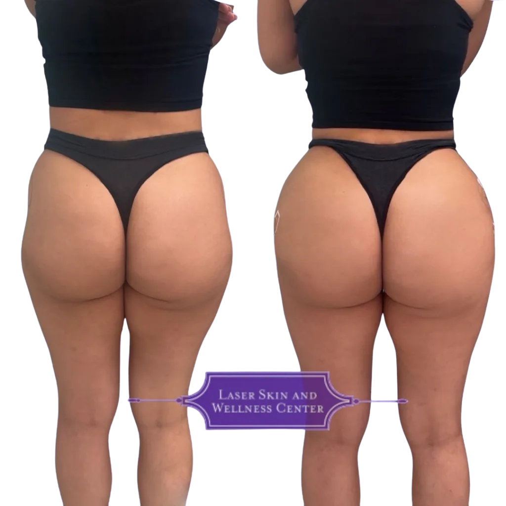 Before and after comparison of non-surgical BBL treatment showing gluteal enhancement from back view with Laser Skin and Wellness Center logo