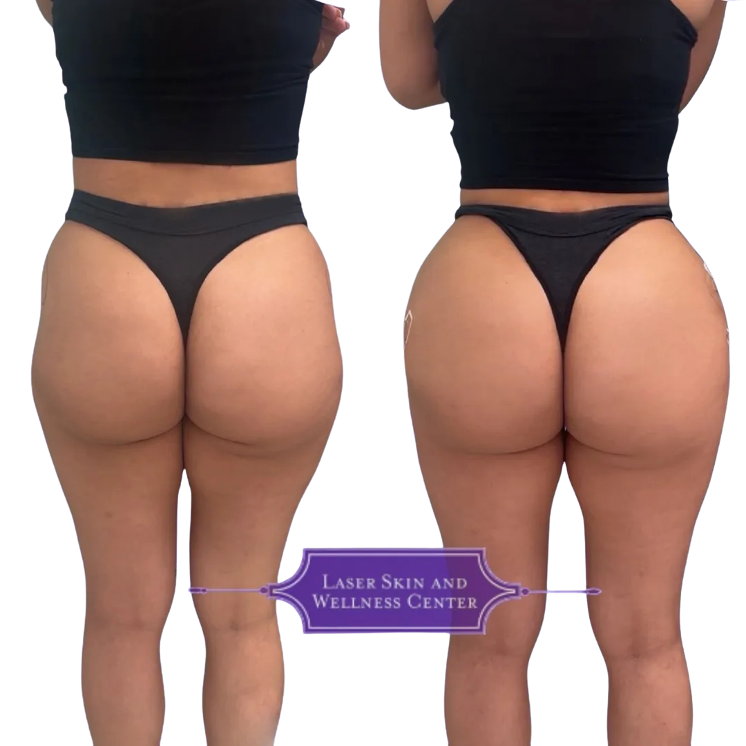 Before and after comparison of non-surgical BBL treatment showing gluteal enhancement from back view with Laser Skin and Wellness Center logo