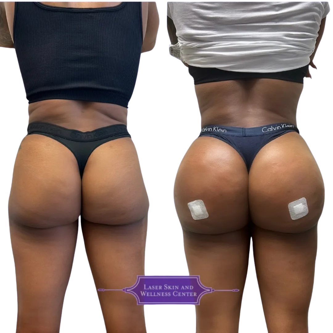 Before and after comparison of non-surgical BBL treatment showing gluteal enhancement from back view with Laser Skin and Wellness Center logo