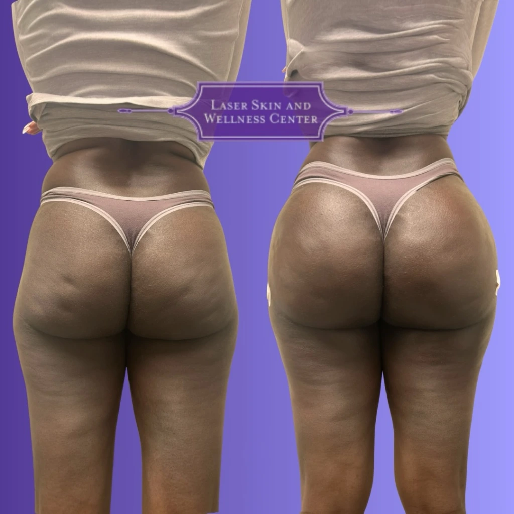 Before and after non-surgical buttock lift on purple background showing lifted and rounded contours