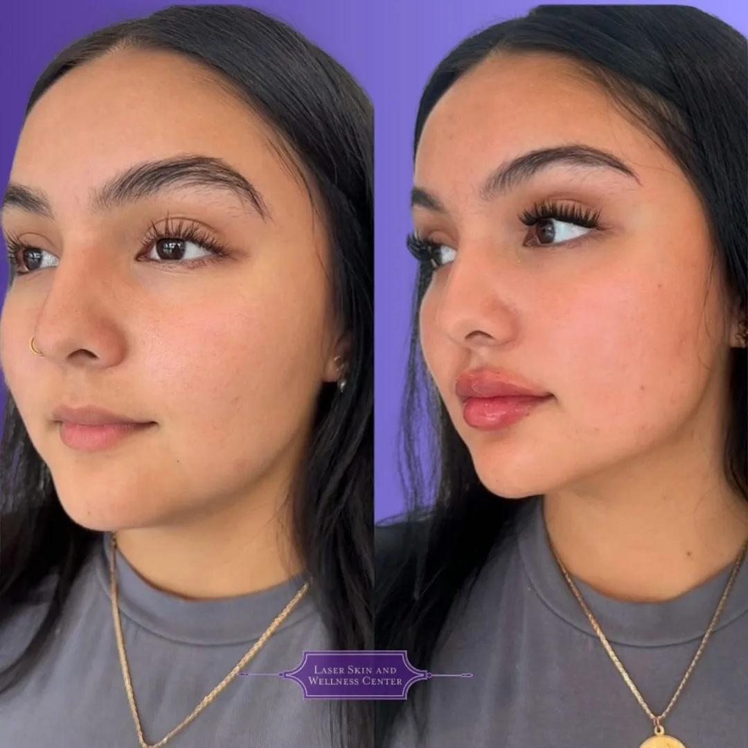 Before and after dermal filler treatment showing enhanced lip volume and definition from side profile