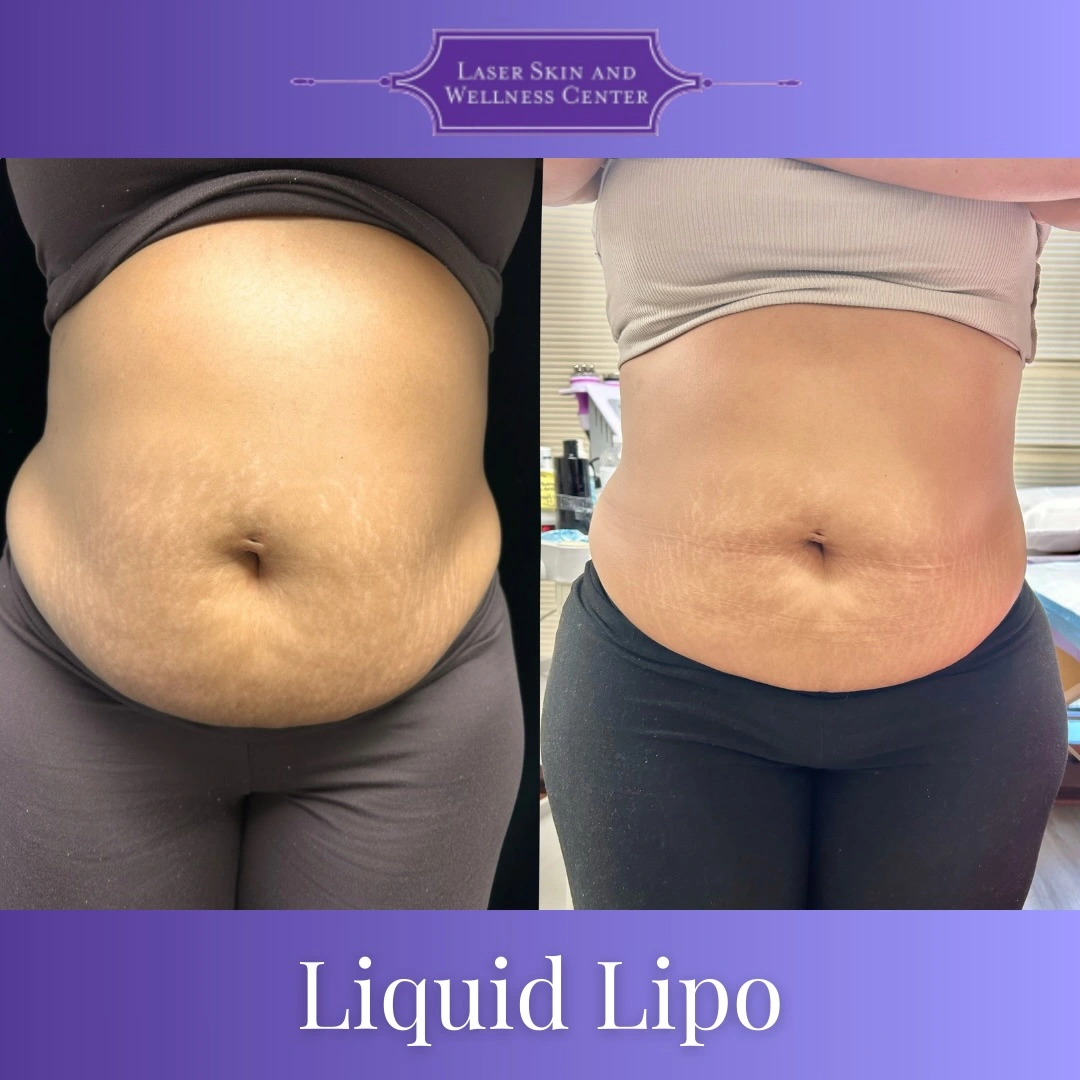 Before and after liquid lipo treatment showing reduced abdominal bloating and improved waistline