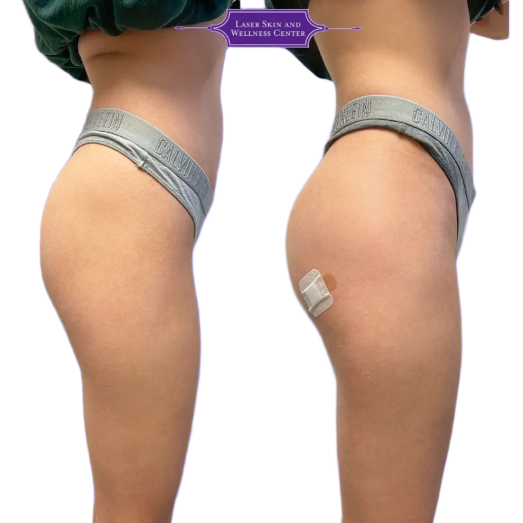 Before and after rear view of buttocks showing increased volume and lift