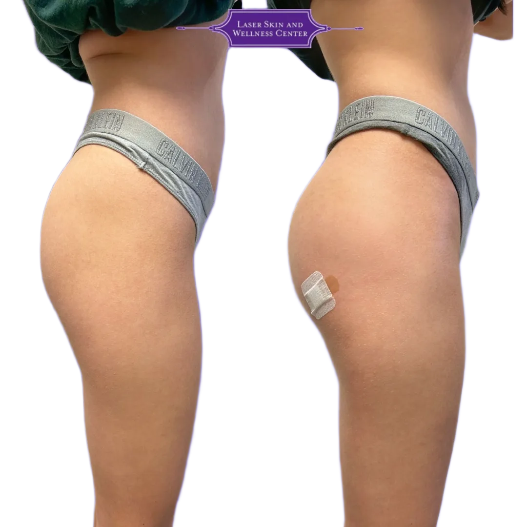 Before and after rear view of buttocks showing increased volume and lift