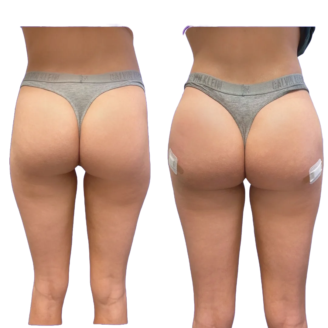 Before and after comparison of non-surgical BBL treatment showing gluteal enhancement from back view