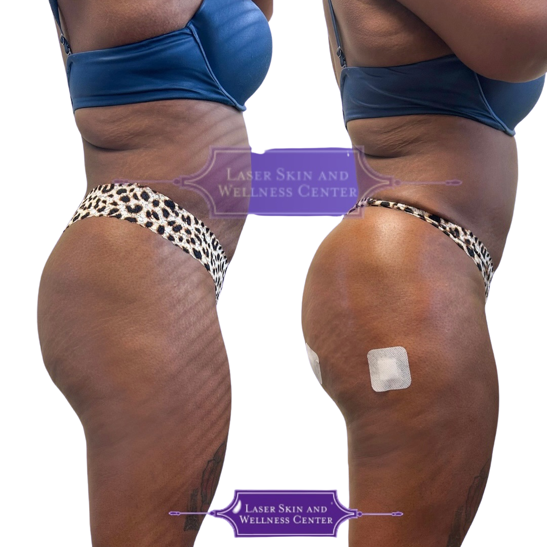 Non Surgical BBL Case 40-1