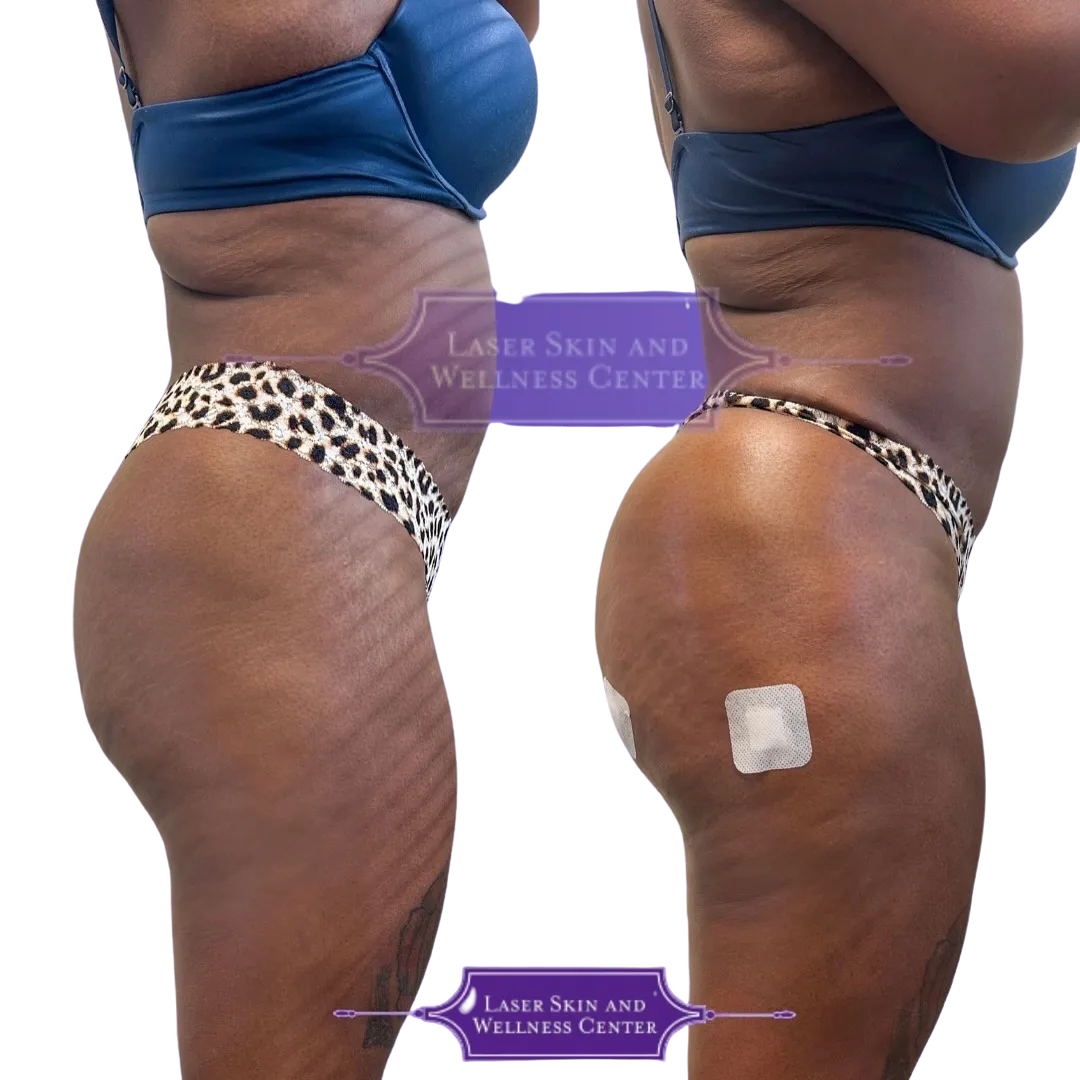 Before and after non-surgical BBL treatment showing reduced cellulite and enhanced buttock contour from side angle