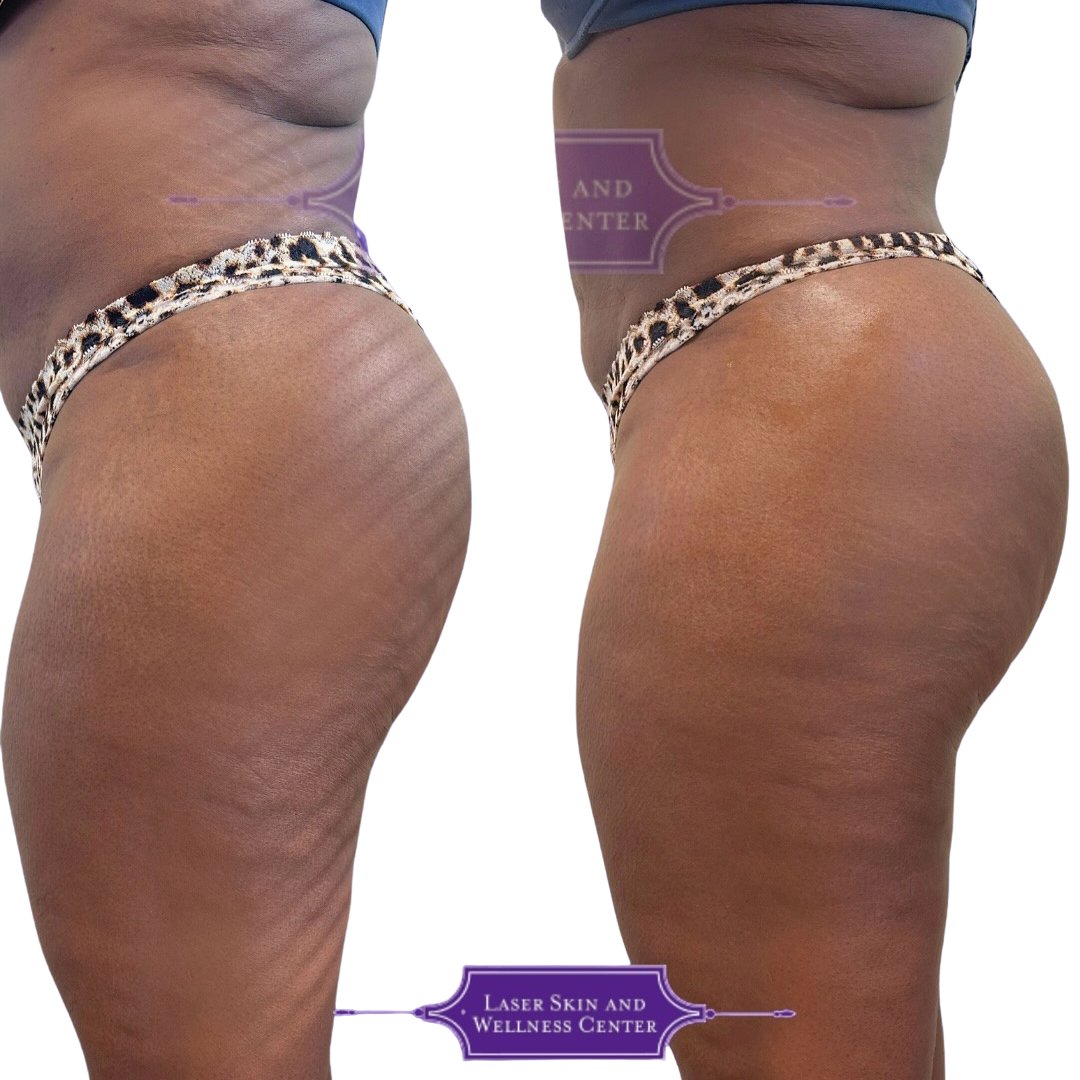 Non Surgical BBL Case 40-2