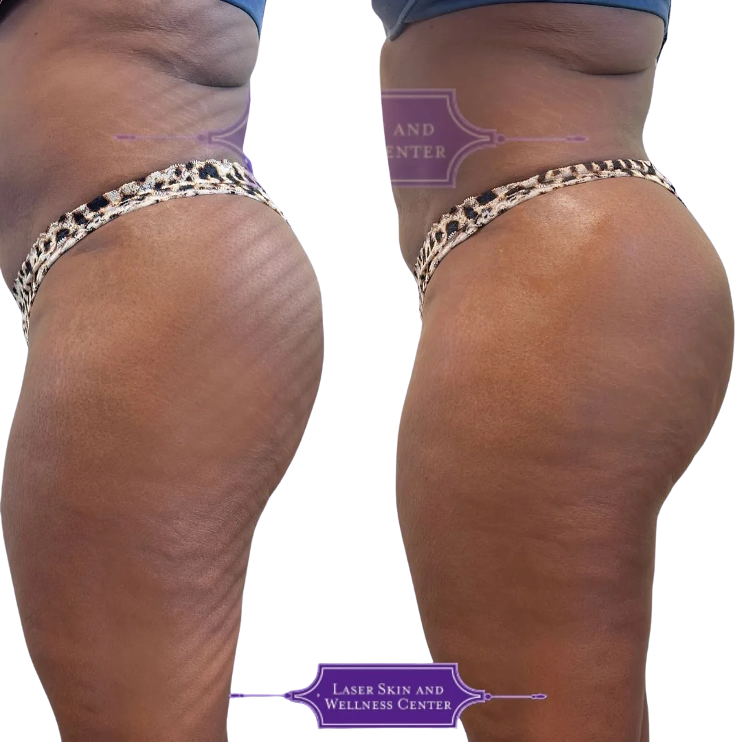 Side profile non-surgical BBL results demonstrating enhanced gluteal projection and reduced cellulite appearance