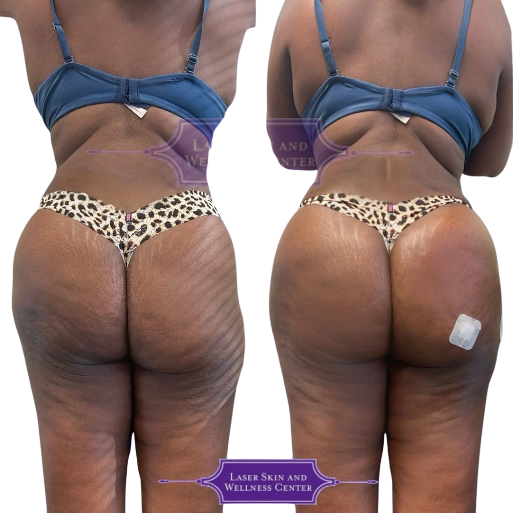 Before and after non-surgical BBL treatment showing improved buttock shape and skin texture from rear view