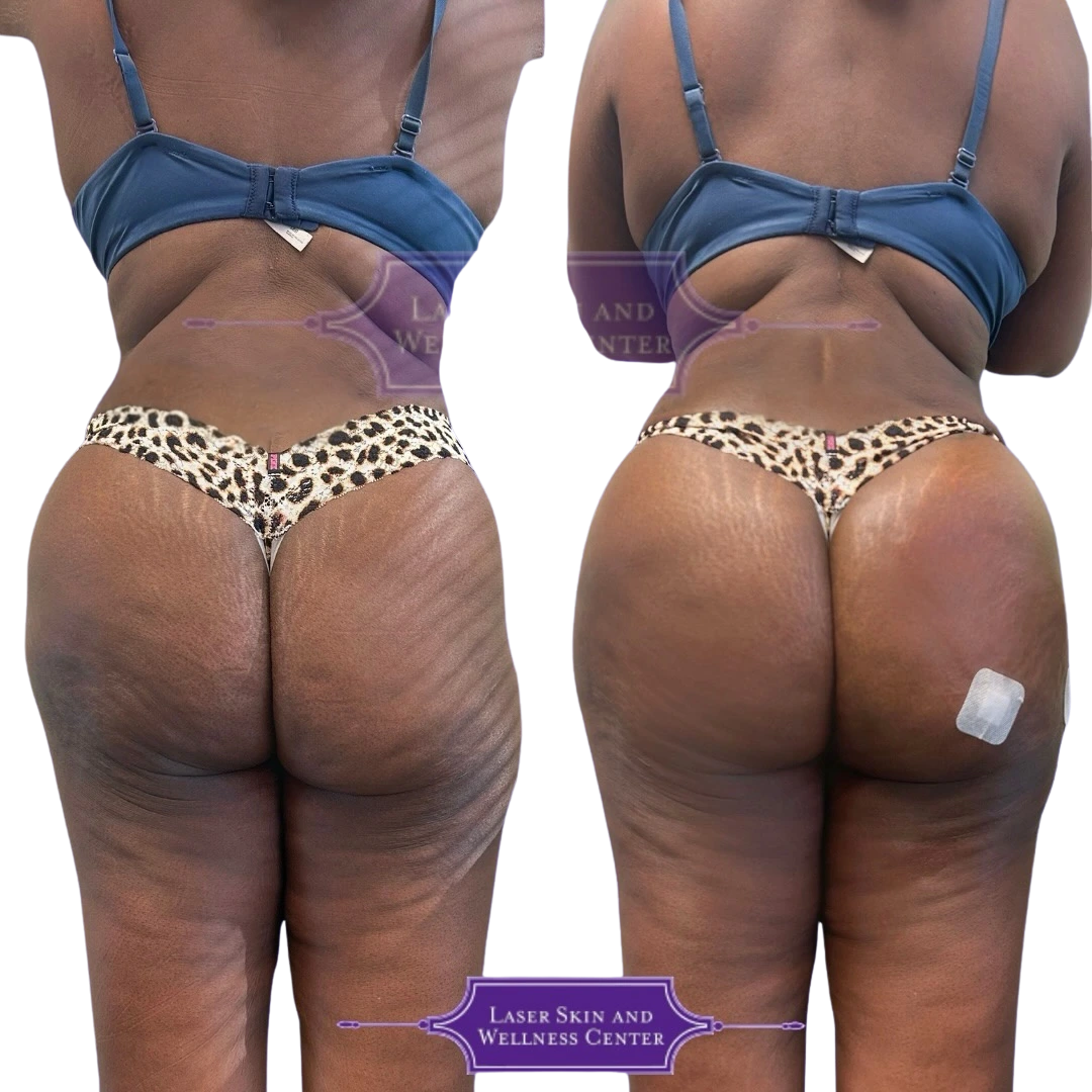 Before and after non-surgical BBL treatment showing improved buttock shape and skin texture from rear view