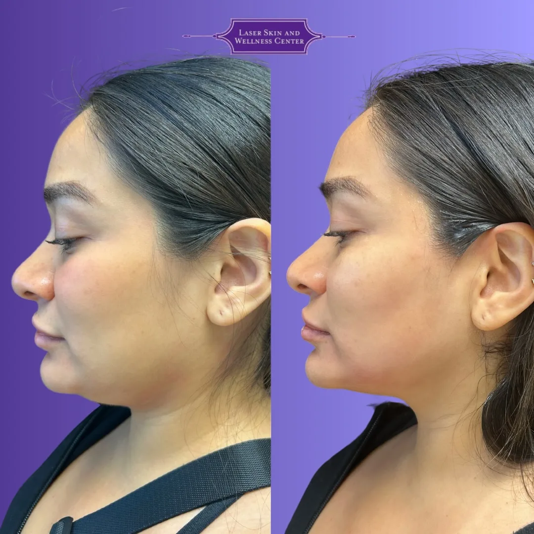 Before and after side profile comparison of skin tightening treatment results