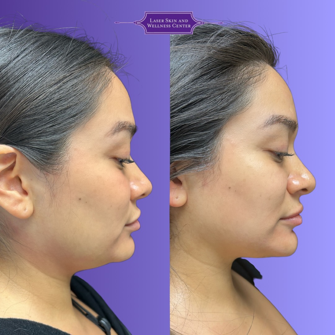 Olgio Skin Tightening Case 4-2