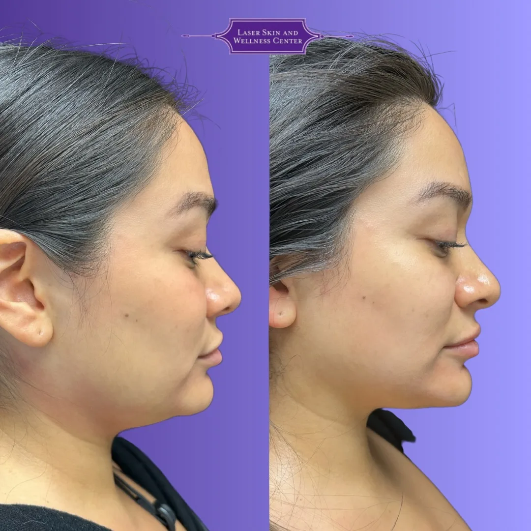 Before and after side profile comparison showing improved skin firmness and definition