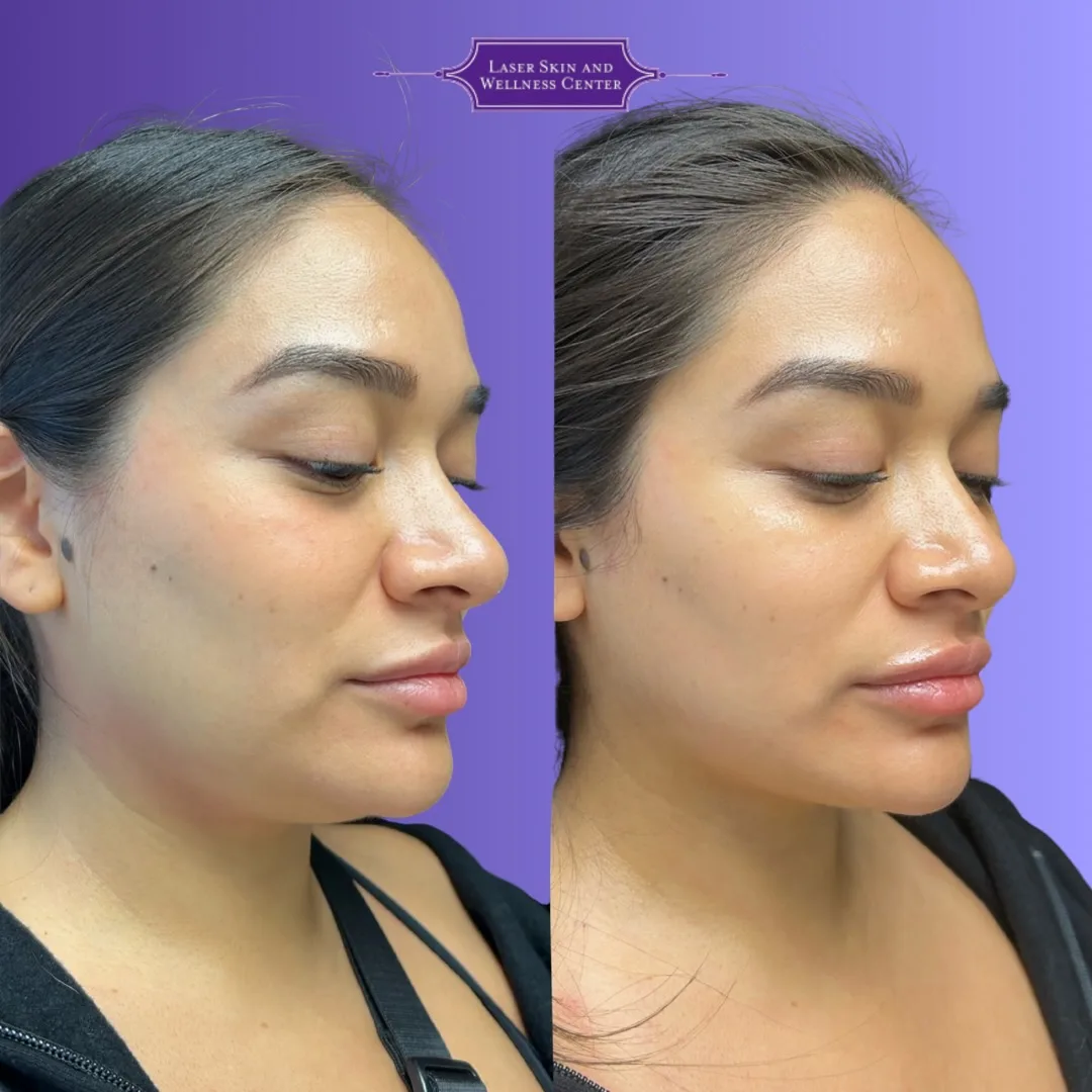 Before and after side profile comparison demonstrating skin tightening treatment outcomes