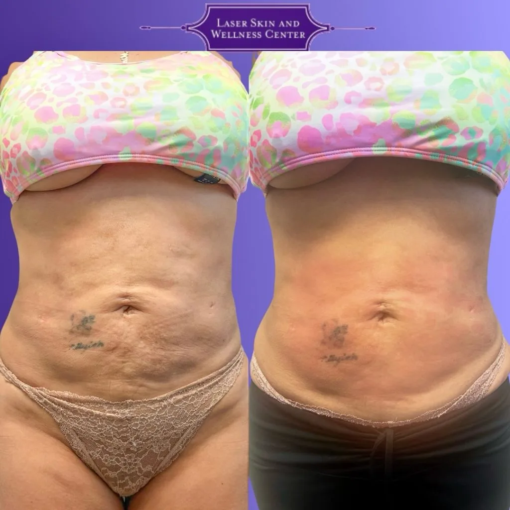 Before and after abdominal skin tightening with Oligio treatment, showing improved skin texture and firmness