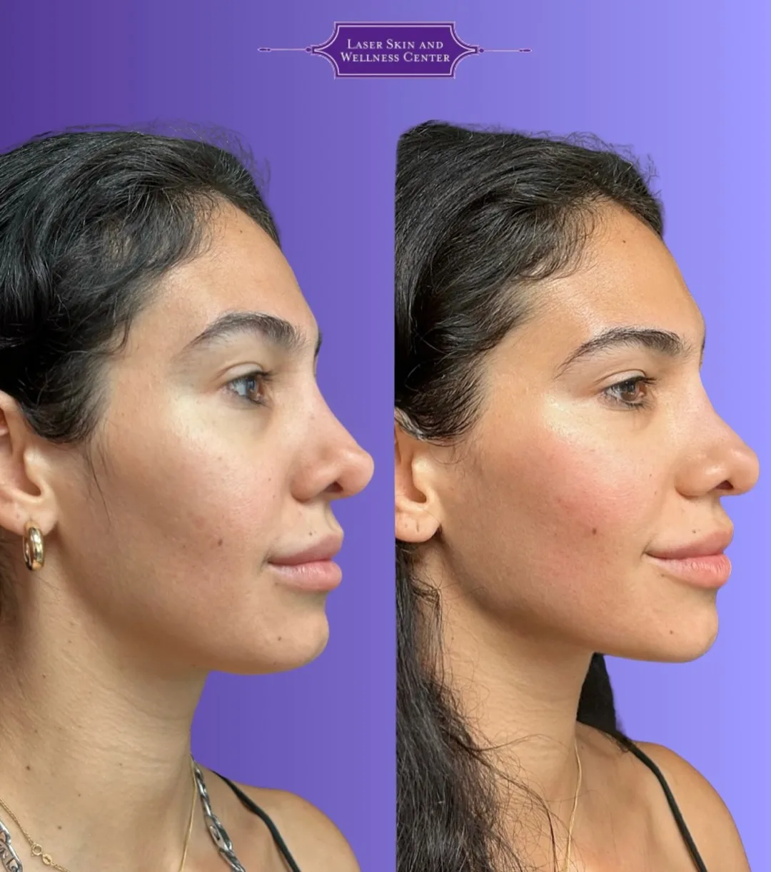 Before and after profile view of face showing improved skin tightness and facial contours with Oligio treatment