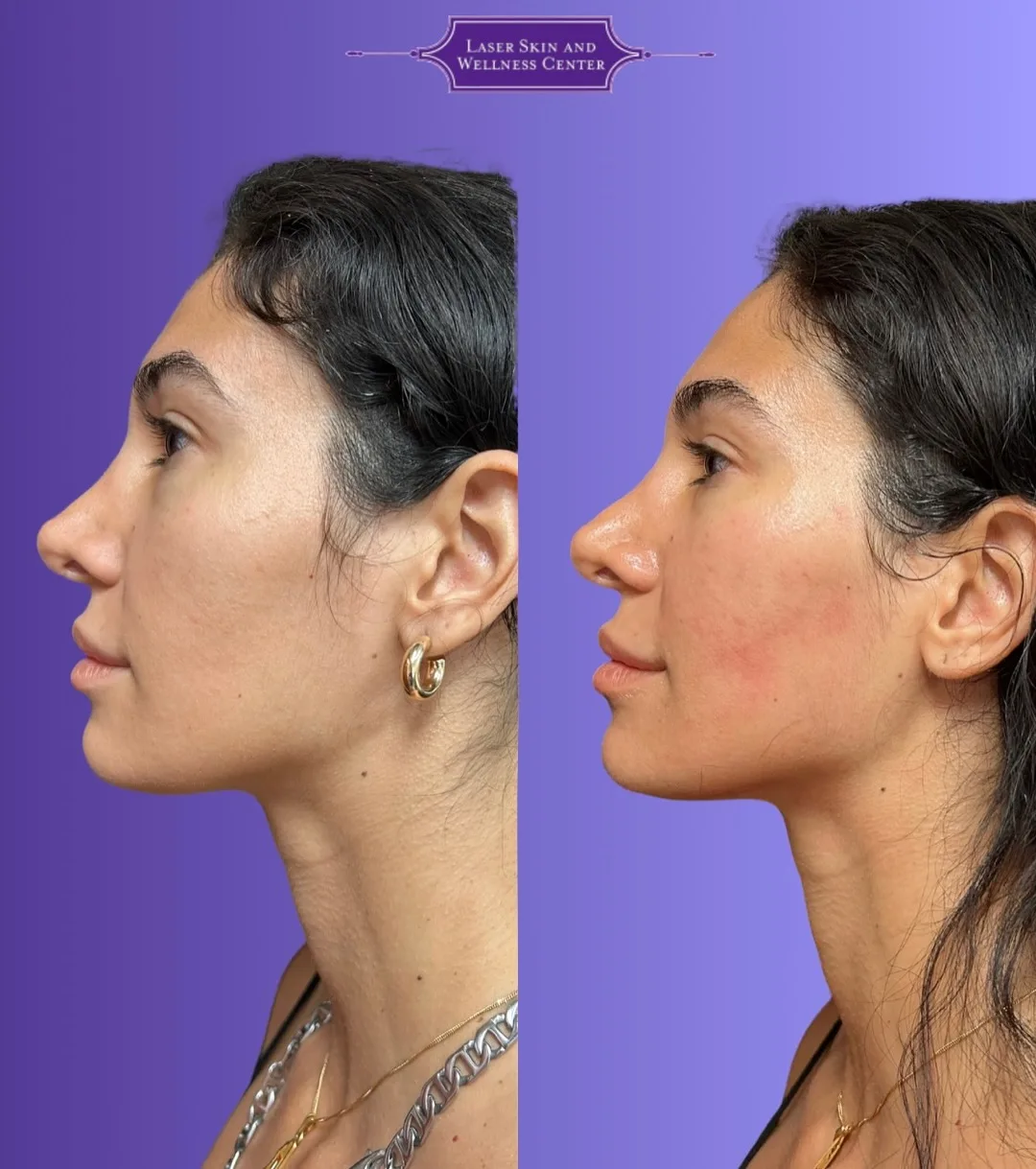 Before and after side profile showing improved skin firmness in jawline and neck area with Oligio treatment