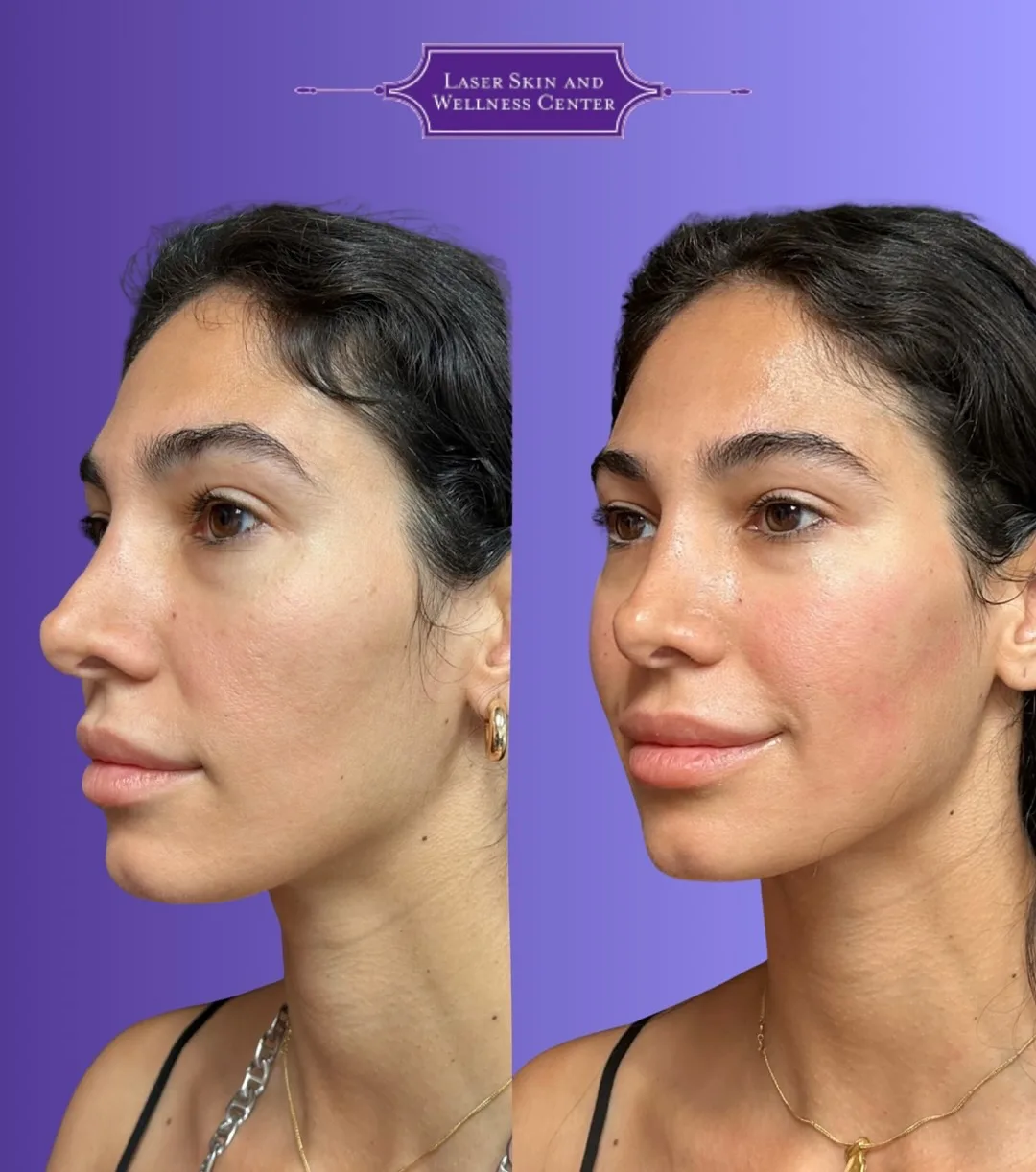 Before and after profile view of face and neck showing enhanced skin tightness and jawline definition with Oligio