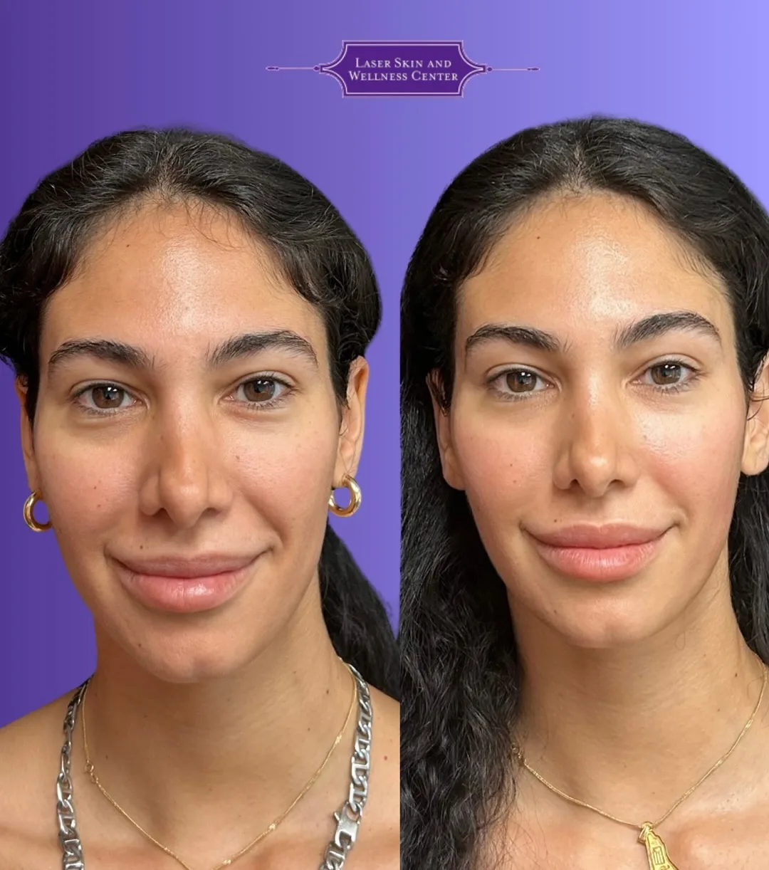 Before and after frontal facial view showing improved skin texture and facial definition with Oligio skin tightening