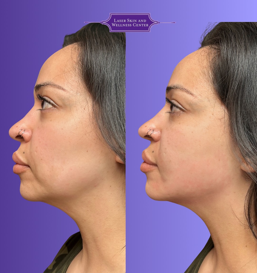 Oligio Skin Tightening Case 7-2