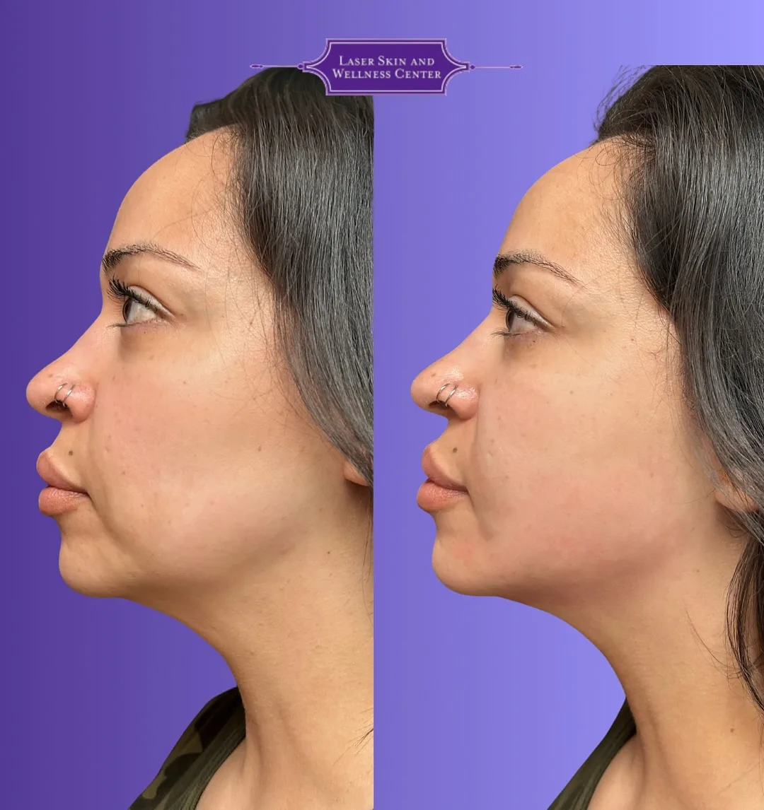 Before and after profile view showing improved facial contours and skin tightness with Oligio skin tightening treatment