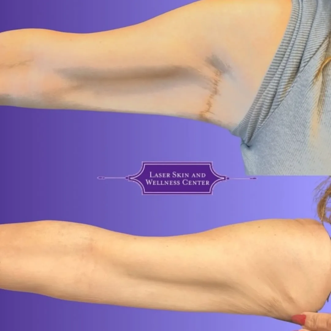 Before and after arm showing reduced appearance of a scar