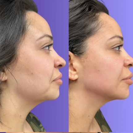 Side-by-side before and after profile view showing facial contouring results
