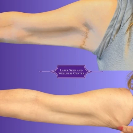 Before and after comparison of arm skin texture on purple background with Laser Skin and Wellness Center logo