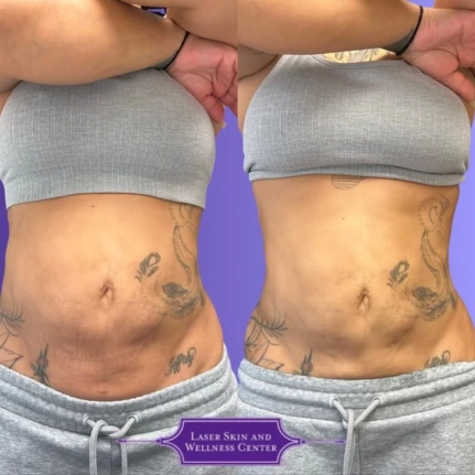 Before and after abdominal skin appearance comparison on purple background with clinic logo