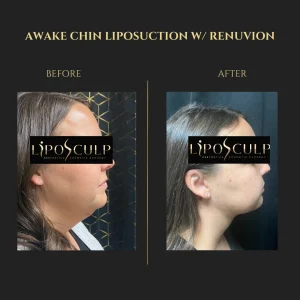 Before and After Chin Liposuction with Renuvion B Banner