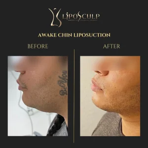 Before and After Chin Liposuction with Renuvion A Banner