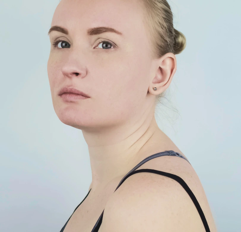 Candidates for Buffalo Hump Liposuction Banner
