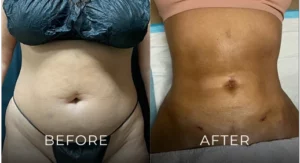 Liposuction Before And After Results Banner