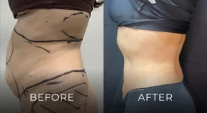 Liposuction Before And After Results Banner