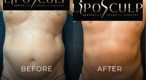 Liposuction Before And After Results Banner