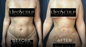 Liposuction Before And After Results Banner