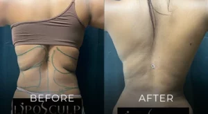 Liposuction Before And After Results Banner
