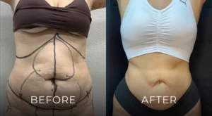 Liposuction Before And After Results Banner